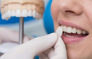 Licówki: Twój sekret olśniewającego uśmiechu